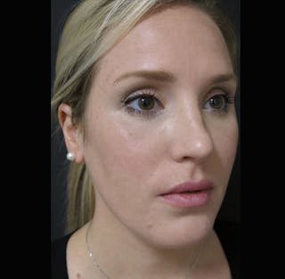 Lip Augmentation Before & After Gallery - Patient 298783 - Image 6