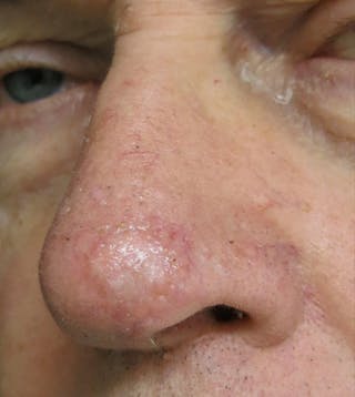 Skin Cancer Reconstruction Before & After Gallery - Patient 122909258 - Image 2