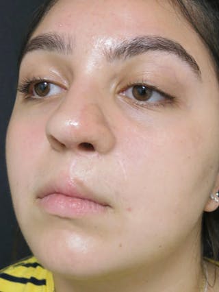 Nasal Reconstruction Before & After Gallery - Patient 122909260 - Image 10