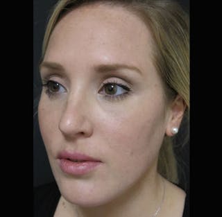 Lip Augmentation Before & After Gallery - Patient 298783 - Image 8
