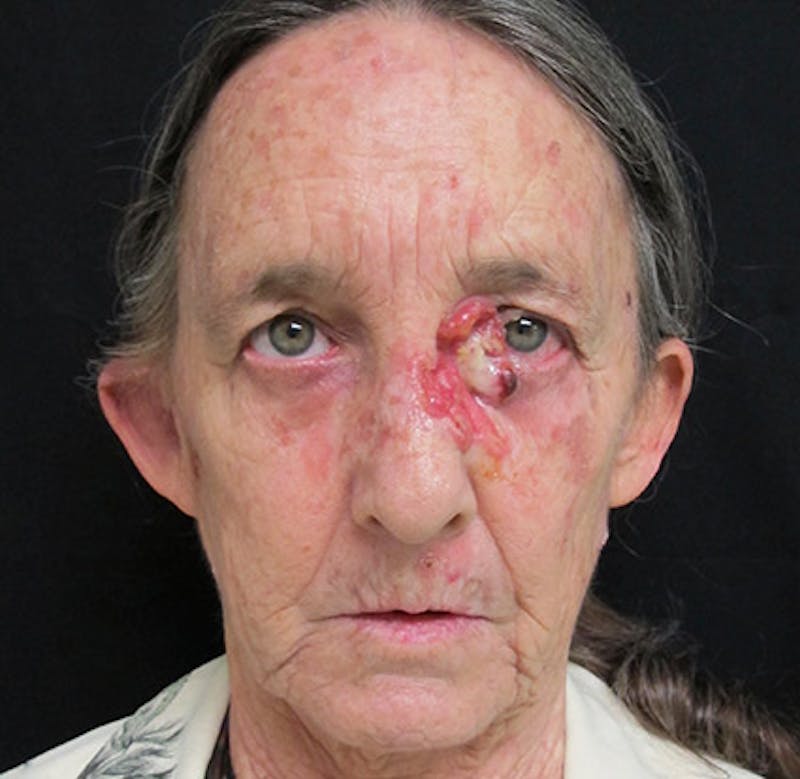 Skin Cancer Reconsruction Before & After Gallery - Patient 122909264 - Image 1