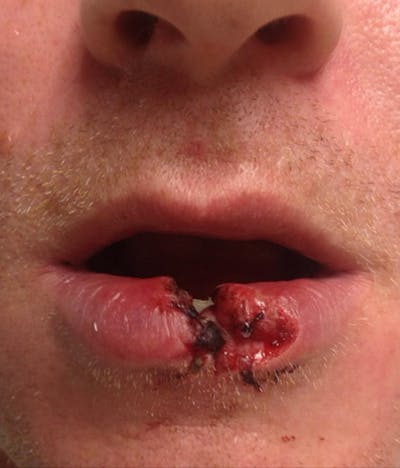 Laceration Repair Before & After Gallery - Patient 122909261 - Image 1