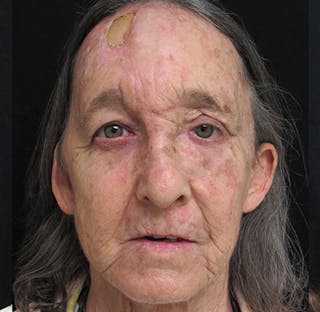 Skin Cancer Reconstruction Before & After Gallery - Patient 122909264 - Image 2