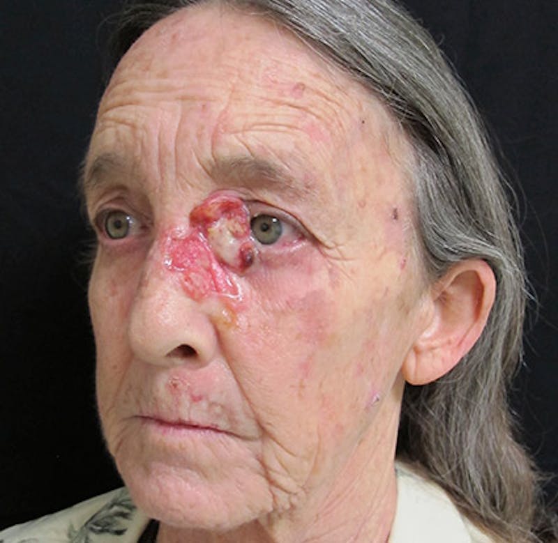 Skin Cancer Reconstruction Before & After Gallery - Patient 122909264 - Image 3