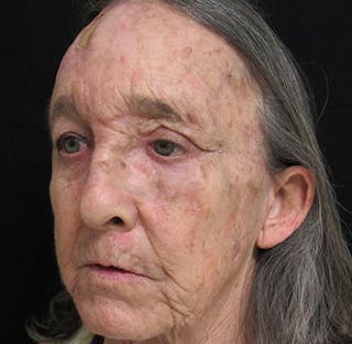 Skin Cancer Reconstruction Before & After Gallery - Patient 122909264 - Image 4