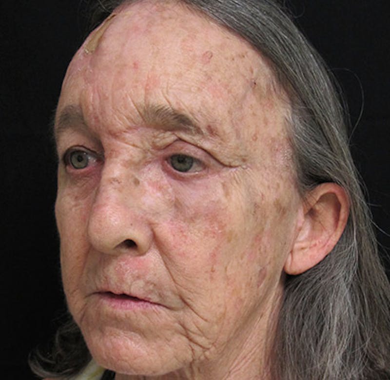 Skin Cancer Reconstruction Before & After Gallery - Patient 122909264 - Image 4