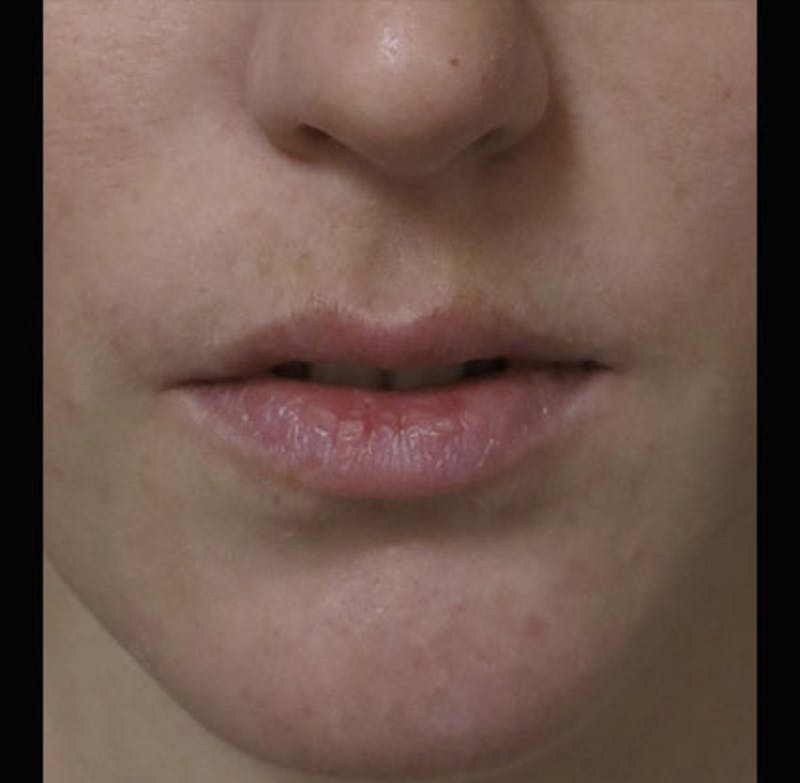 Lip Augmentation Before & After Gallery - Patient 298783 - Image 11