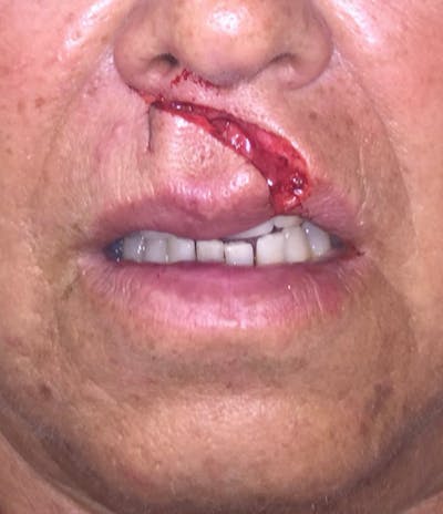 Laceration Repair Before & After Gallery - Patient 122909266 - Image 1