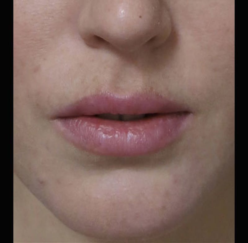 Lip Augmentation Before & After Gallery - Patient 298783 - Image 12