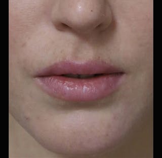 Lip Augmentation Before & After Gallery - Patient 122909263 - Image 12