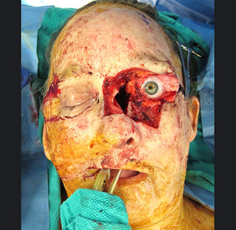 Skin Cancer Reconstruction Before & After Gallery - Patient 122909264 - Image 5