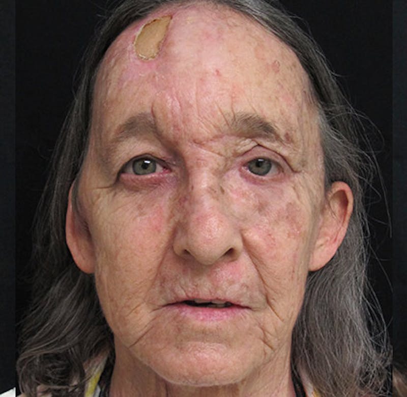 Skin Cancer Reconsruction Before & After Gallery - Patient 122909264 - Image 6
