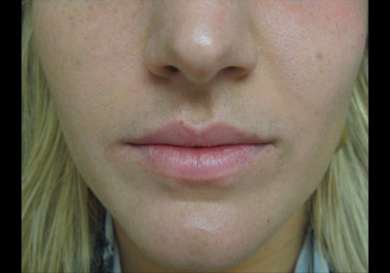 Lip Augmentation Before & After Gallery - Patient 122909269 - Image 1