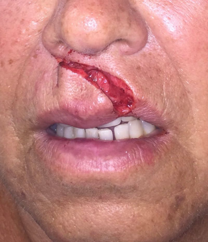 Laceration Repair Before & After Gallery - Patient 122909266 - Image 3