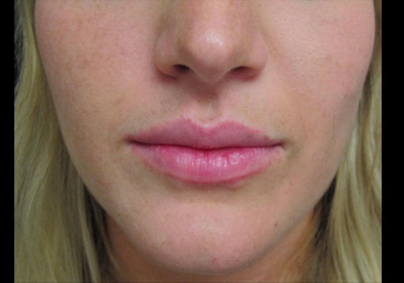 Lip Augmentation Before & After Gallery - Patient 122909269 - Image 2