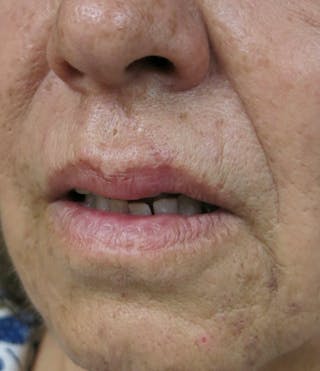 Laceration Repair Before & After Gallery - Patient 122909266 - Image 4