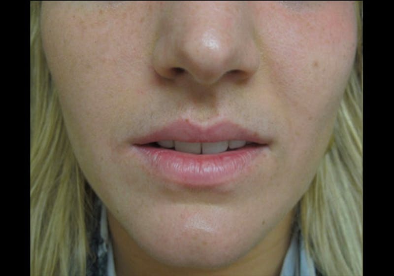 Lip Augmentation Before & After Gallery - Patient 122909269 - Image 3