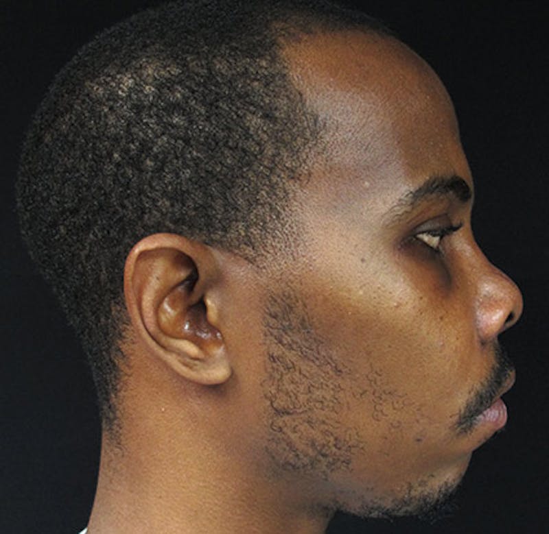 Nasal Reconstruction Before & After Gallery - Patient 122909268 - Image 8