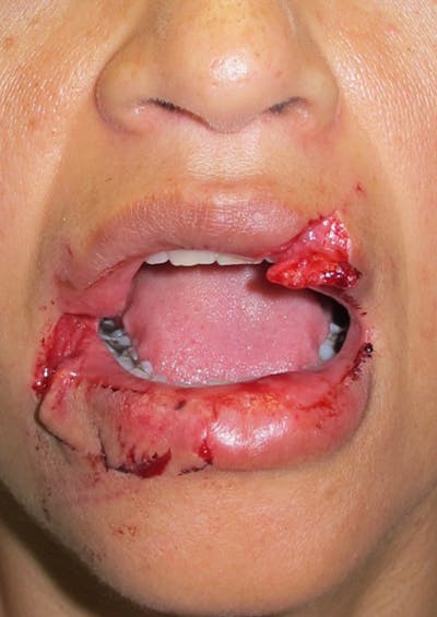 Laceration Repair Before & After Gallery - Patient 122909270 - Image 1