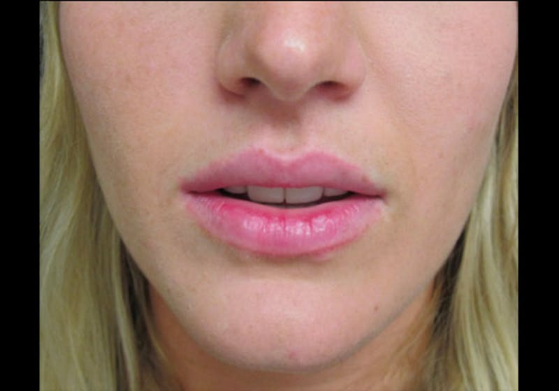 Lip Augmentation Before & After Gallery - Patient 122909269 - Image 4