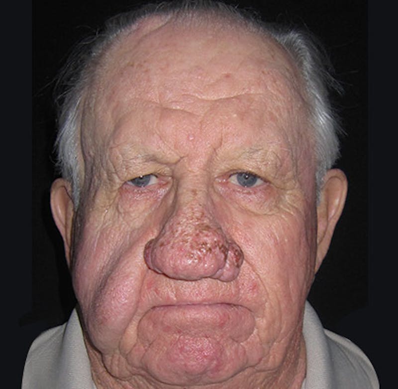 Nasal Reconstruction Before & After Gallery - Patient 122909276 - Image 1