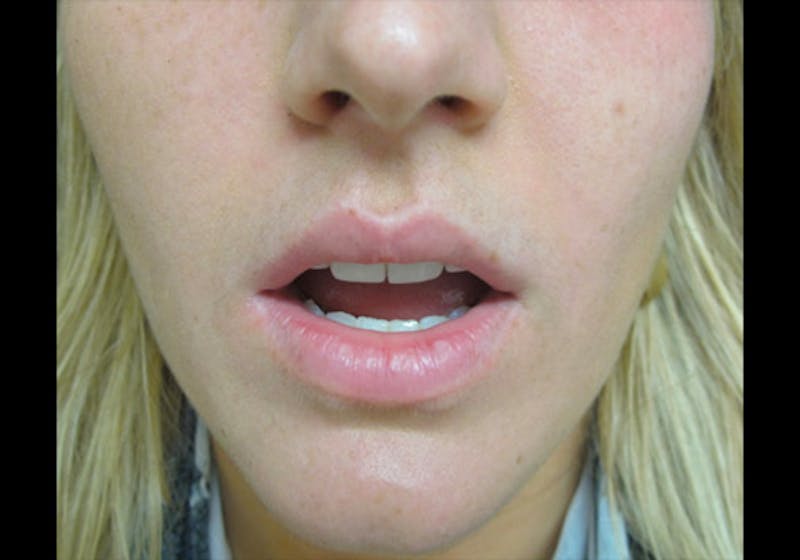 Lip Augmentation Before & After Gallery - Patient 122909269 - Image 5