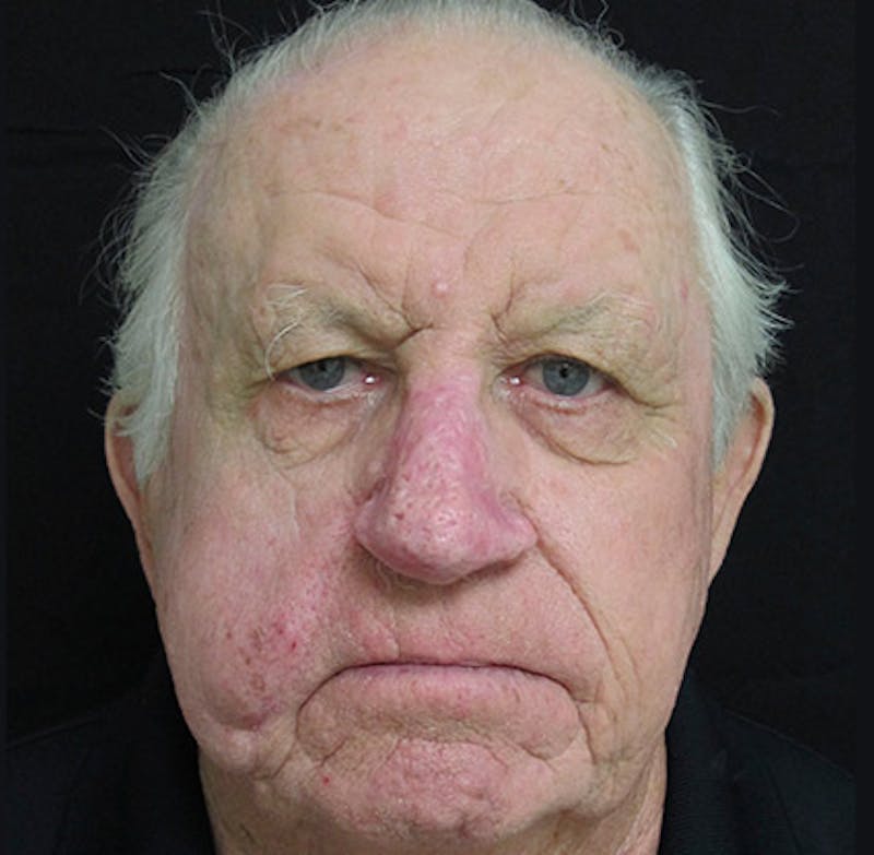 Nasal Reconstruction Before & After Gallery - Patient 122909276 - Image 2