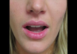 Lip Augmentation Before & After Gallery - Patient 122909269 - Image 6