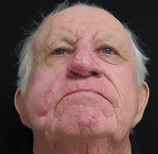 Nasal Reconstruction Before & After Gallery - Patient 122909276 - Image 4