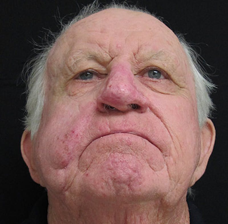 Nasal Reconstruction Before & After Gallery - Patient 122909276 - Image 4