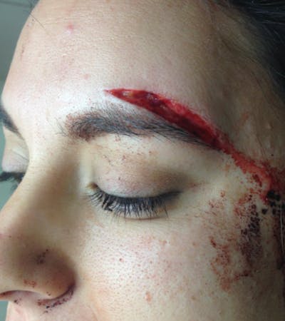 Laceration Repair Before & After Gallery - Patient 122909272 - Image 1