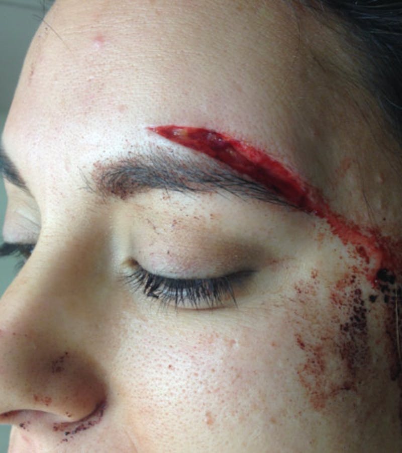 Laceration Repair Before & After Gallery - Patient 122909272 - Image 1