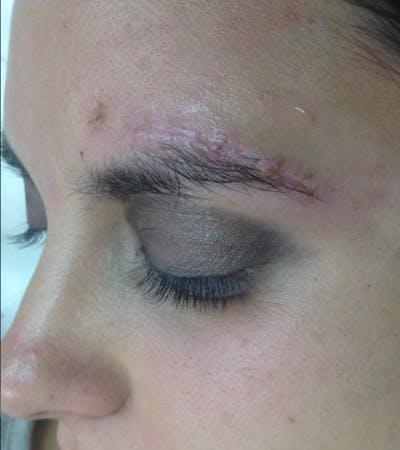 Laceration Repair Before & After Gallery - Patient 122909272 - Image 2