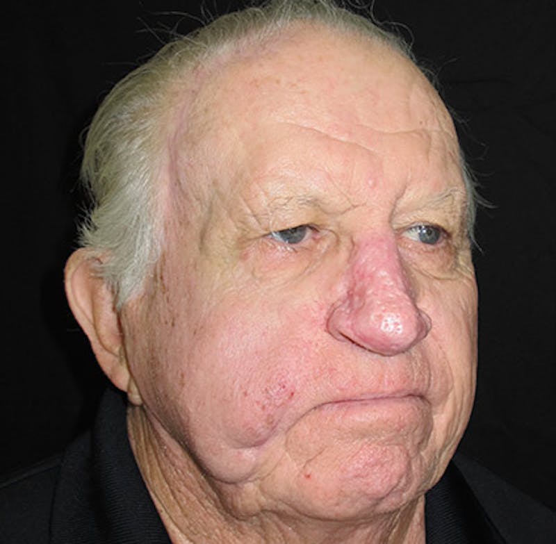 Nasal Reconstruction Before & After Gallery - Patient 122909276 - Image 6