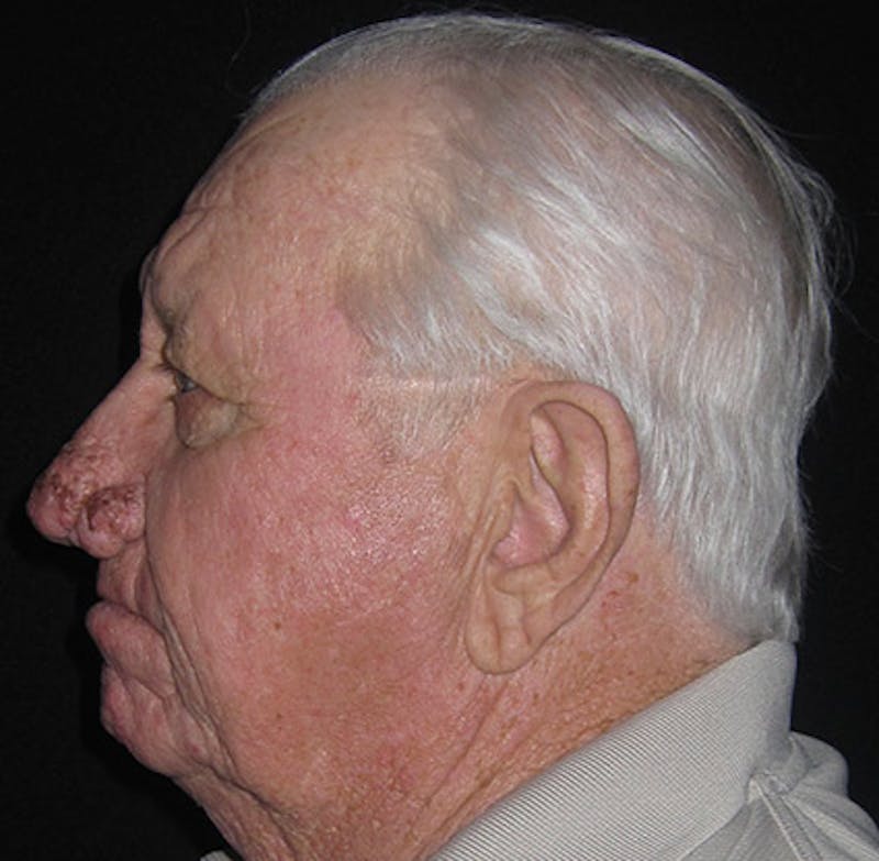 Nasal Reconstruction Before & After Gallery - Patient 122909276 - Image 7