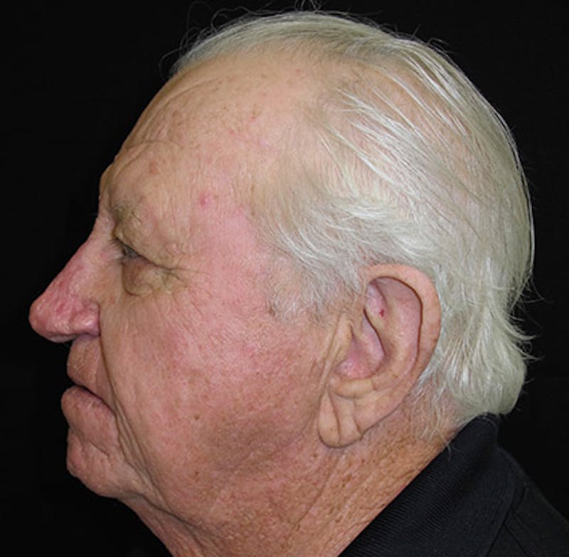 Nasal Reconstruction Before & After Gallery - Patient 122909276 - Image 8