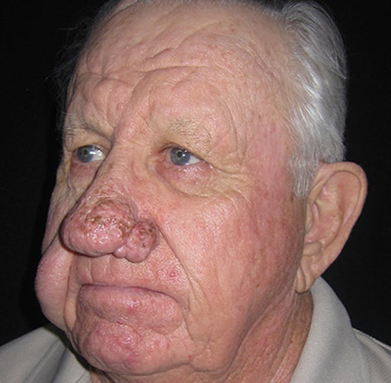Nasal Reconstruction Before & After Gallery - Patient 122909276 - Image 9