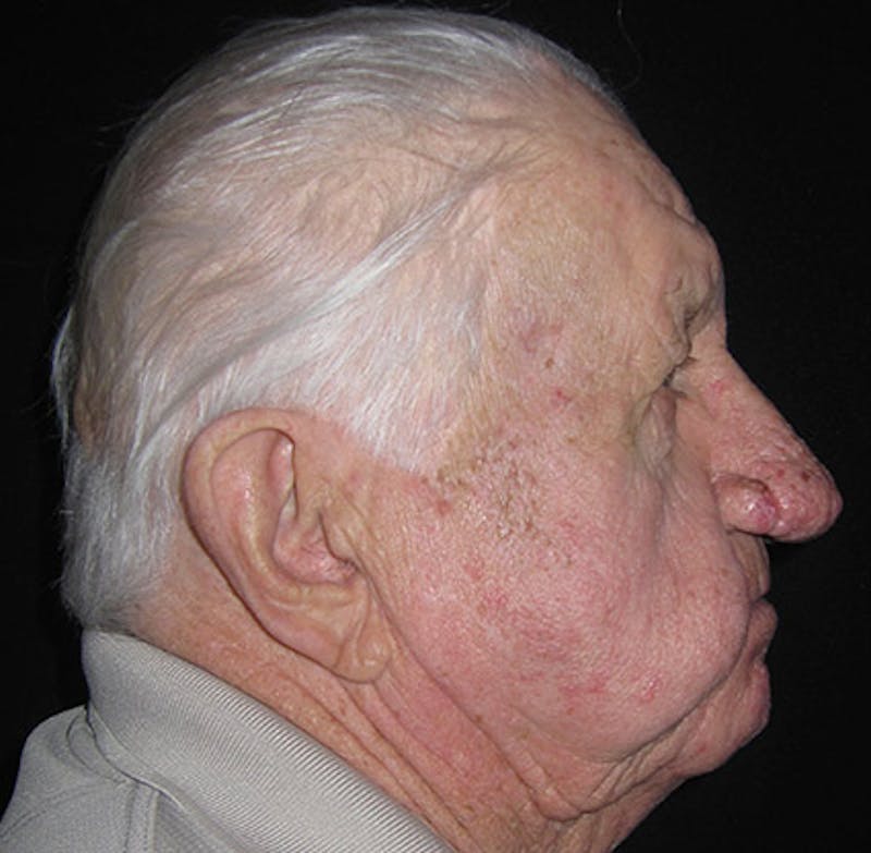 Nasal Reconstruction Before & After Gallery - Patient 122909276 - Image 11