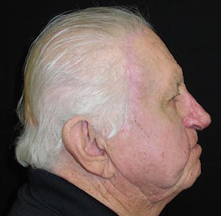 Nasal Reconstruction Before & After Gallery - Patient 122909276 - Image 12