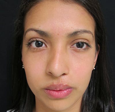 Nasal Reconstruction Before & After Gallery - Patient 122909281 - Image 1