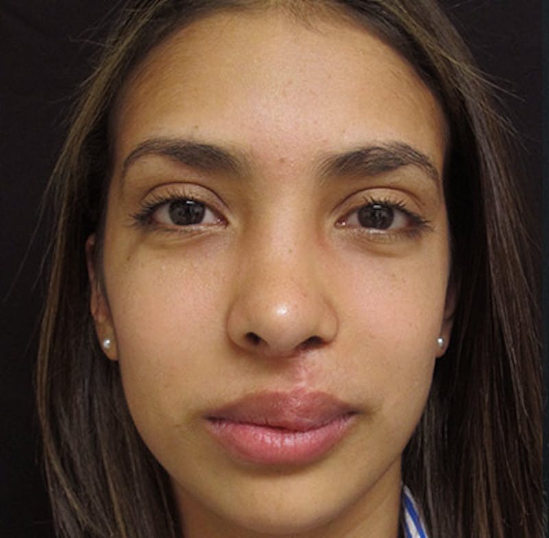 Nasal Reconstruction Before & After Gallery - Patient 122909281 - Image 2