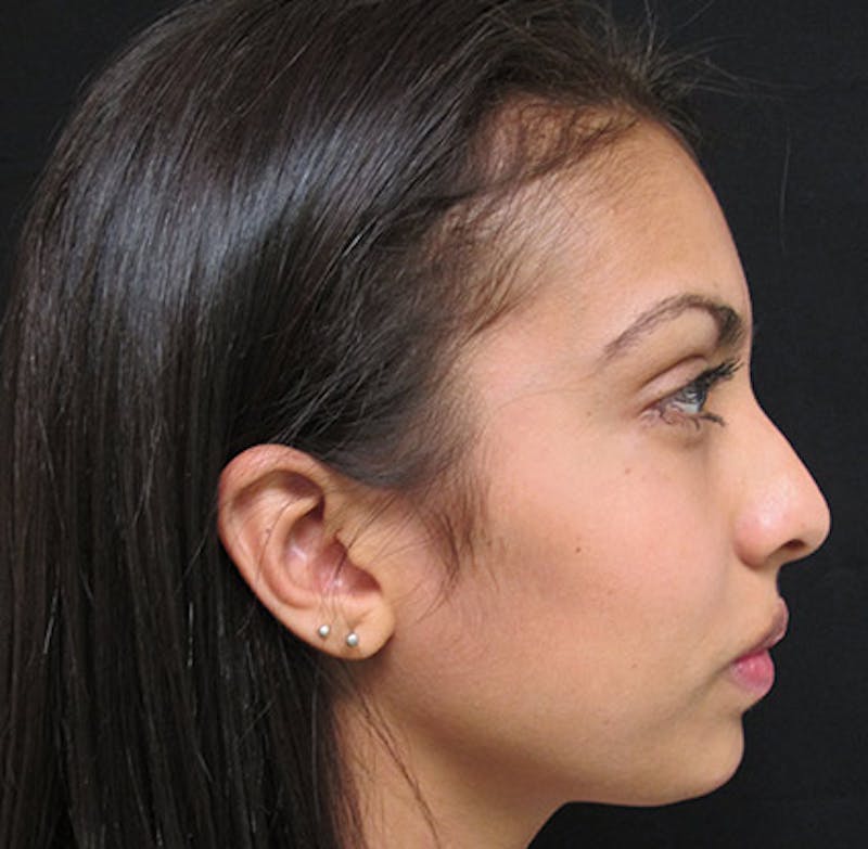Nasal Reconstruction Before & After Gallery - Patient 122909281 - Image 3