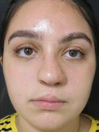 Trauma Reconstruction Before & After Gallery - Patient 122909277 - Image 6