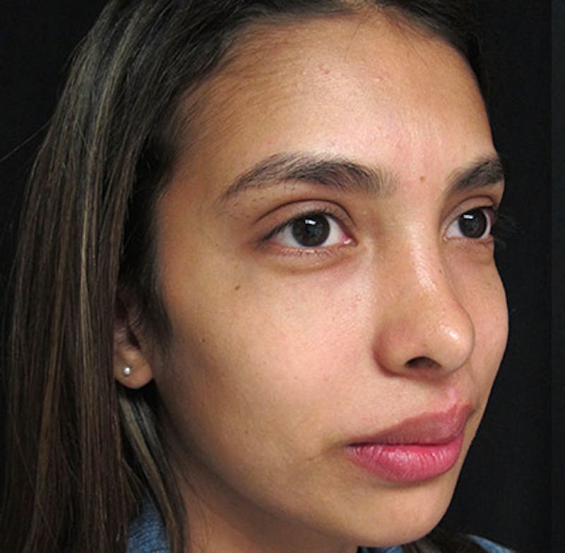 Nasal Reconstruction Before & After Gallery - Patient 122909281 - Image 6