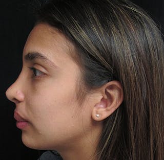 Nasal Reconstruction Before & After Gallery - Patient 122909281 - Image 8