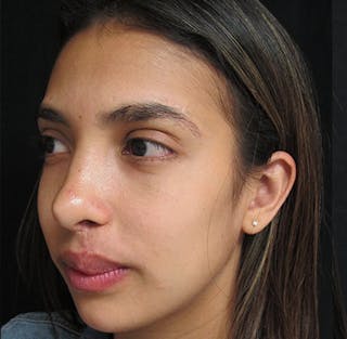 Nasal Reconstruction Before & After Gallery - Patient 122909281 - Image 10