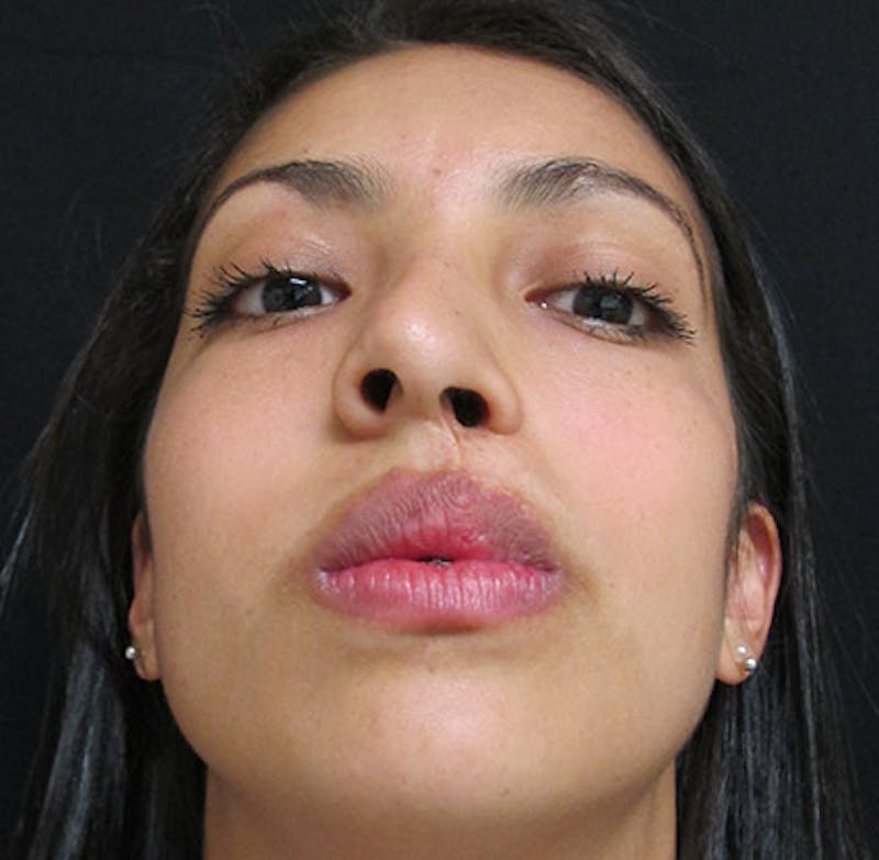 Nasal Reconstruction Before & After Gallery - Patient 122909281 - Image 11