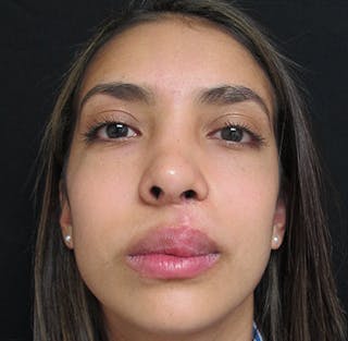 Nasal Reconstruction Before & After Gallery - Patient 122909281 - Image 12