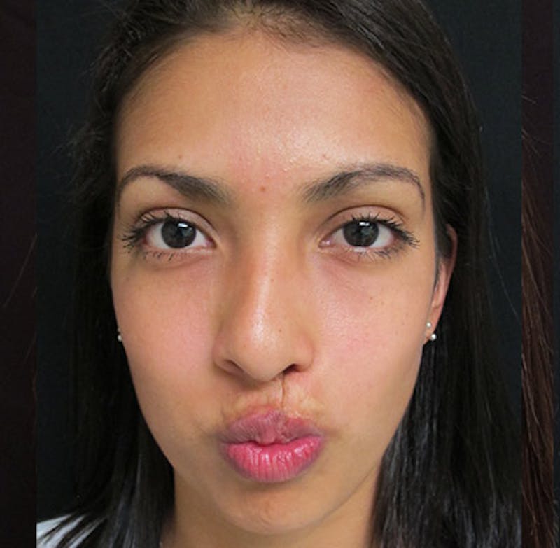 Nasal Reconstruction Before & After Gallery - Patient 122909281 - Image 13