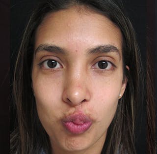 Nasal Reconstruction Before & After Gallery - Patient 122909281 - Image 14